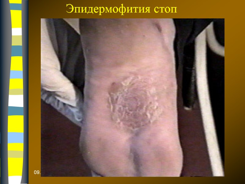 09.12.2017 Эпидермофития стоп